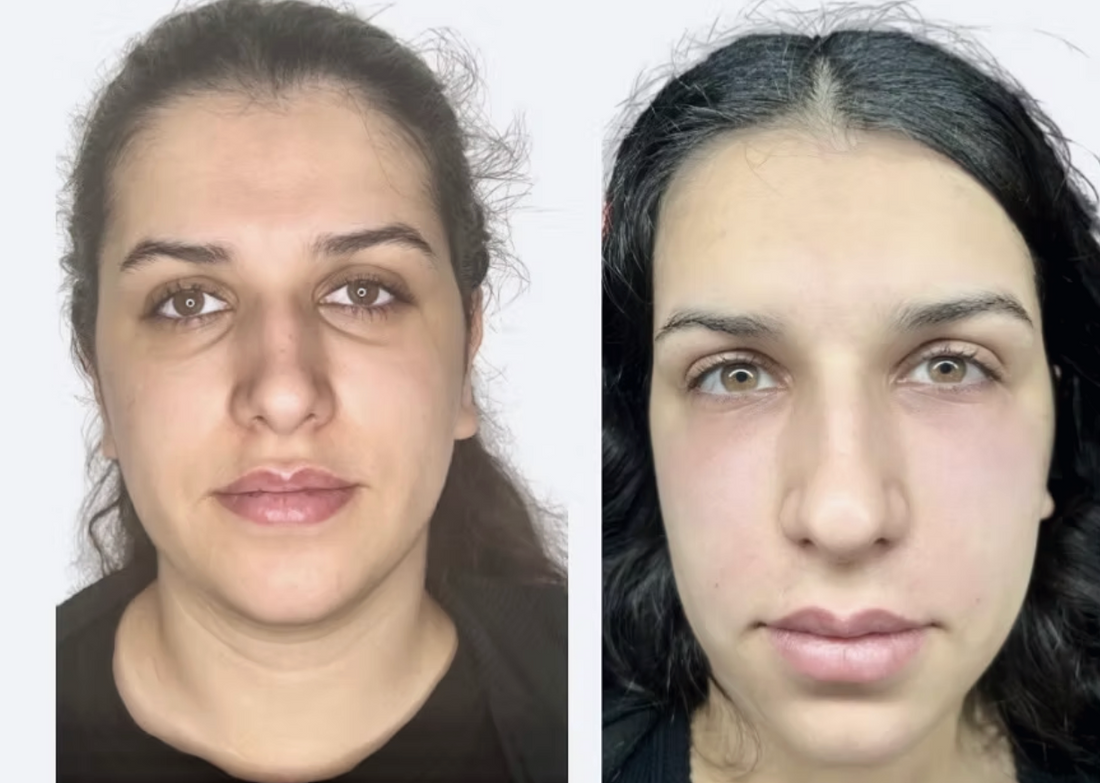 Skip the Synthetic: Embrace PRF for Radiant, Natural Results